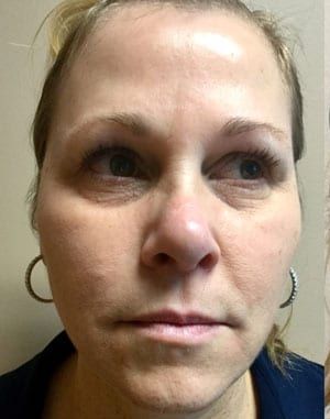 Facial Fat Transfer Before & After Patient #1943