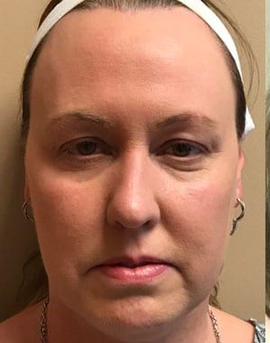 Facial Fat Transfer Before & After Patient #1944