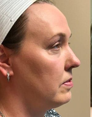 Facial Fat Transfer Before & After Patient #1944