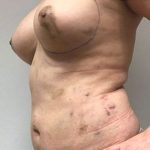 Fat Transfer To Breast Before & After Patient #2366