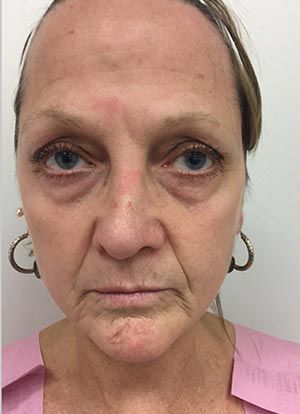 Facial Fat Transfer Before & After Patient #1946