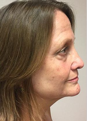 Facial Fat Transfer Before & After Patient #1946