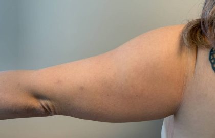 Arm Liposuction Before & After Patient #1025