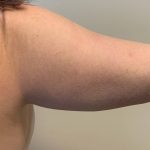 Arm Liposuction Before & After Patient #1025