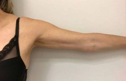 Arm Liposuction Before & After Patient #1034
