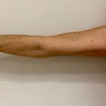 Arm Liposuction Before & After Patient #1034