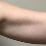 Arm Liposuction Before & After Patient #1039