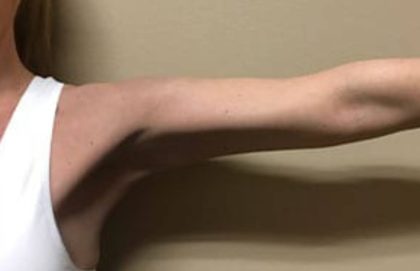 Arm Liposuction Before & After Patient #1042