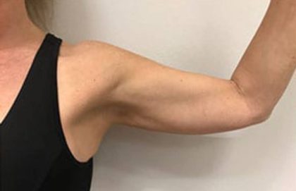 Arm Liposuction Before & After Patient #1042