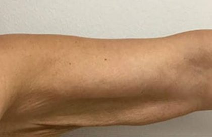 Arm Liposuction Before & After Patient #1049