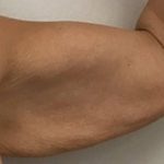 Arm Liposuction Before & After Patient #1049