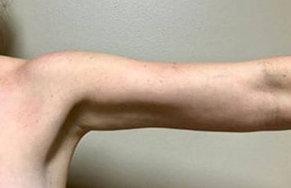 Arm Liposuction Before & After Patient #1054