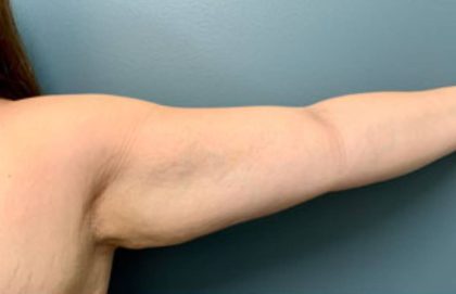 Arm Liposuction Before & After Patient #1074