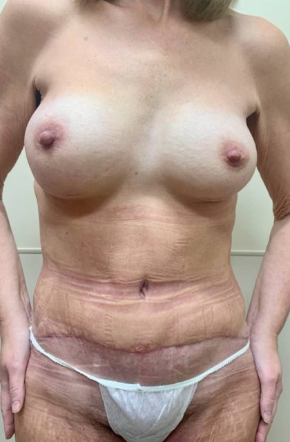 After Weight Loss Surgery Before & After Patient #994
