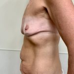 After Weight Loss Surgery Before & After Patient #994