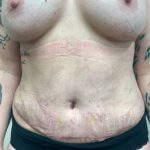 After Weight Loss Surgery Before & After Patient #1009