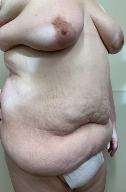 After Weight Loss Surgery Before & After Patient #1005