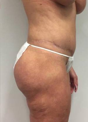 Lower Body Lift Before & After Patient #1152