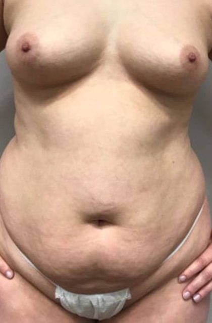 Liposuction Before & After Patient #1109