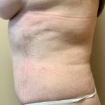 Liposuction Before & After Patient #1114