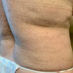 Liposuction Before & After Patient #1114