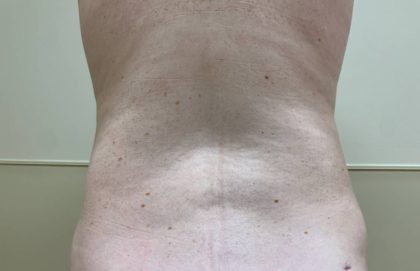Liposuction Before & After Patient #1126