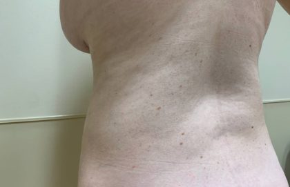 Liposuction Before & After Patient #1126