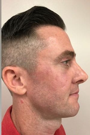 Facial Fat Transfer Before & After Patient #1949