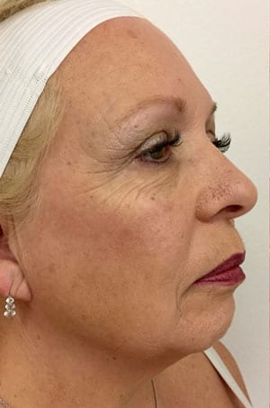 Facelift Before & After Patient #1896