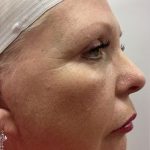 Facelift Before & After Patient #1896