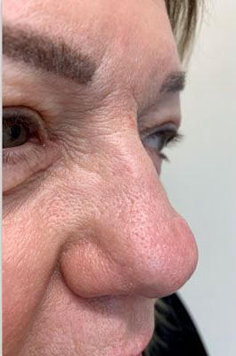 Rhinoplasty Before & After Patient #2219