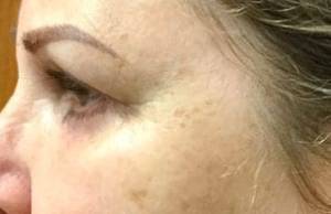 Eyelid Lift Before & After Patient #3017