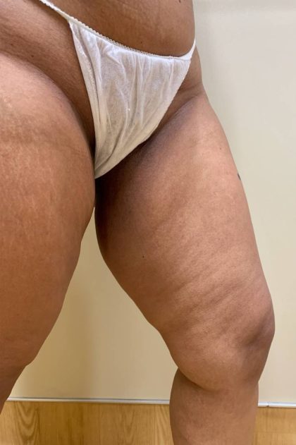 Thigh Lift Before & After Patient #2888