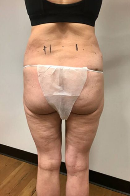 Thigh Lift Before & After Patient #2902