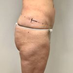 Thigh Lift Before & After Patient #2902