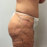 Thigh Lift Before & After Patient #2910