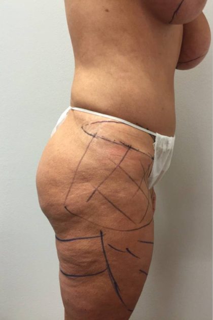 Thigh Lift Before & After Patient #2910