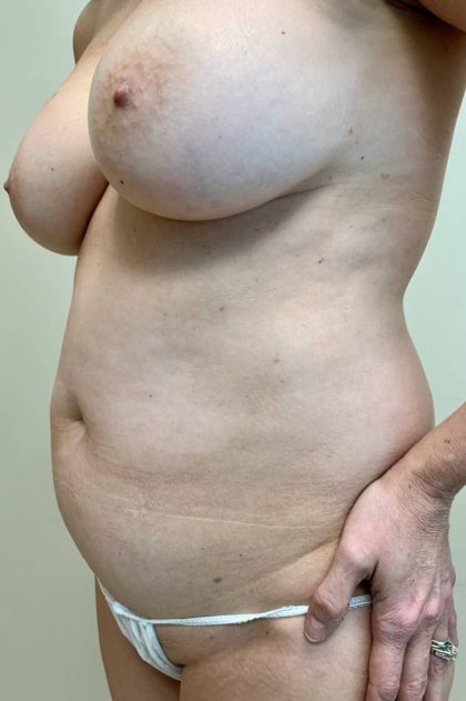 Tummy Tuck Before & After Patient #2923