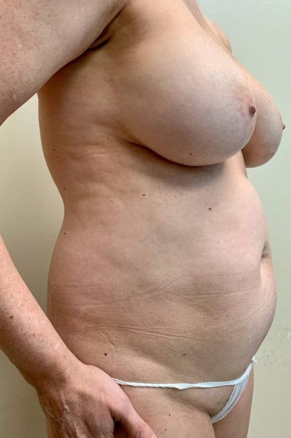 Tummy Tuck Before & After Patient #2923