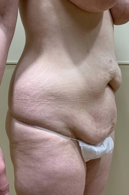 Tummy Tuck Before & After Patient #2945