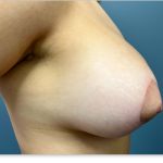 Breast Lift With Augmentation Before & After Patient #3269
