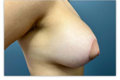 Breast Lift With Augmentation Before & After Patient #3269