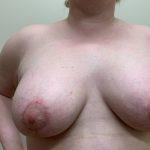 Breast Lift With Augmentation Before & After Patient #3292