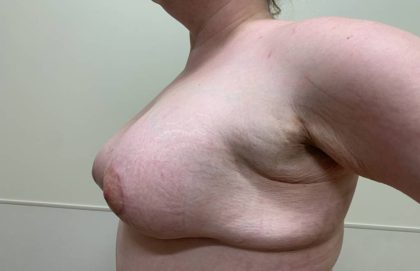 Breast Lift With Augmentation Before & After Patient #3292