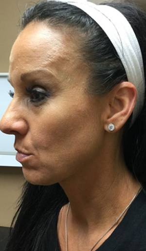 Women's Injectables Before & After Patient #3296