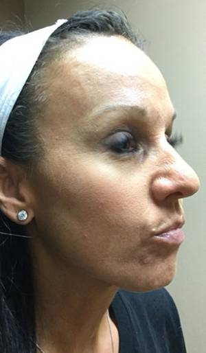 Women's Injectables Before & After Patient #3296