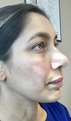 Women's Injectables Before & After Patient #3309