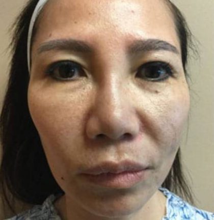 Women's Injectables Before & After Patient #3332