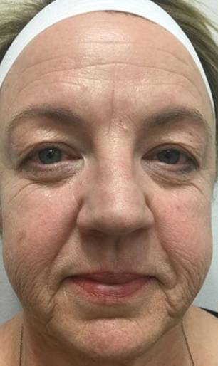 Women's Injectables Before & After Patient #3348