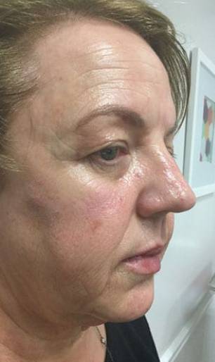 Women's Injectables Before & After Patient #3348